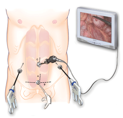 During laparoscopic surgery, surgical instruments and a tiny camera are inserted through small ports in the abdomen.