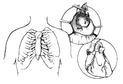 An Illustration from The Columbia Presbyterian Guide to Surgery By Eric A. Rose, MD