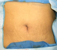 Now, natural orifice translumenal endoscopic surgery (NOTES) eliminates even those small scars.