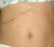 In the past, gallbladder surgery required major abdominal surgery that left patients with a long scar.