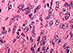 Fig 2. Anaplastic thyroid cancer tissue. The tumor cells grow in solid clusters. Some of the tumor cells are spindle shaped.