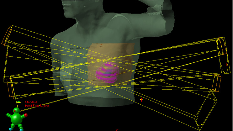 This figure shows the three-dimensional conformal radiation therapy (3D-CRT) APBI technique.