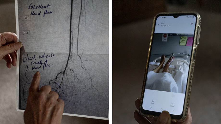  Images from the New York Times by Cydni Elledge showing Hanna (interviewed for the NYT article on Predatory PAD) sharing images of her arteries and leg prior to amputation. 