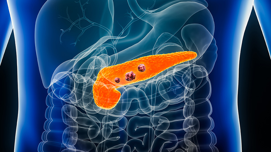 3D illustration of a human abdomen showing the pancreas with cancer cells and surrounding organs