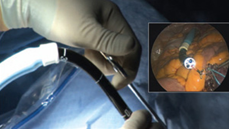 The Columbia team performed the first transvaginal gallbladder removal operation in the U.S. in March 2007. Inset: A magnified scope provides excellent imaging of the interior anatomy, allowing for precise placement of the tiny instruments.