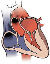 Color illustration of a cross section of the human heart with mitral prolapse
