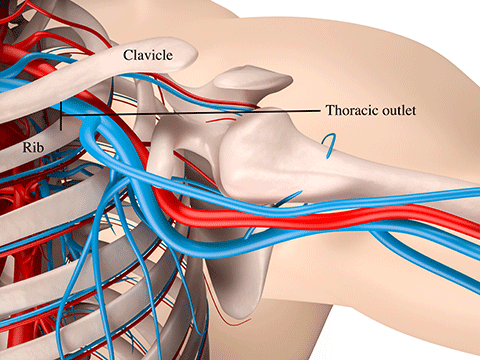 3D illustration showing that the thoracic outlet, a space between the collarbone, or clavicle, and the first rib, is crowded with blood vessels. Also crowding this space, but not depicted, are nerves and muscles.