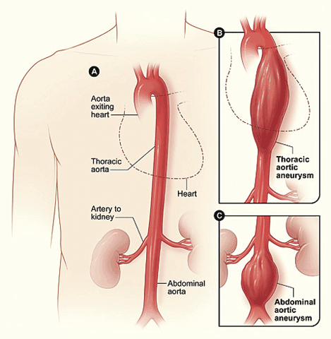 An aneurysm may develop in any part of the aorta. Aneurysms involving both thoracic and abdominal sections may require complex treatment such as an elephant trunk procedure.