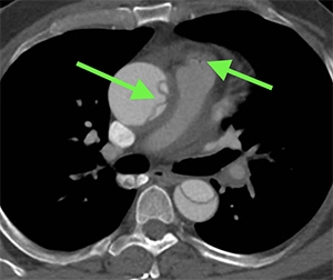 CT angiogram (axial view) of acute type A aortic dissection. A flap is seen in the ascending and descending aorta. Note aneurysmal ascending aorta, which is a lot larger than the descending aorta.