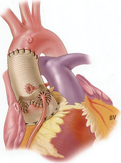 Illustration shows an aortic root repaired in a valve-sparing root replacement (David) procedure