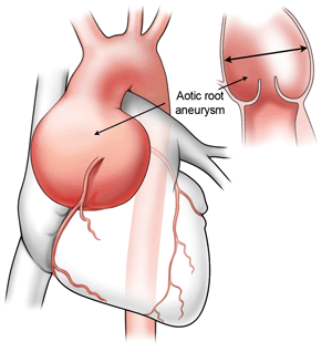 Enlarged aorta