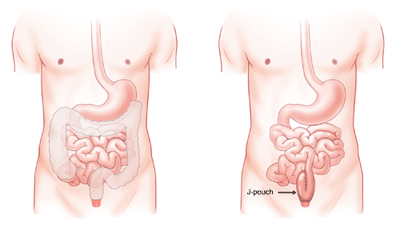 When the large intestine and rectum are removed due to colorectal disease, another pathway must be devised for solid waste to exit the body. A J-pouch, a surgically created 