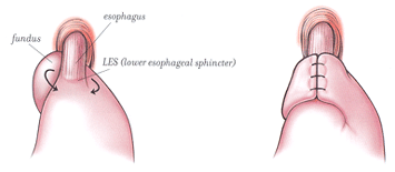 The fundus (top of stomach) is wrapped around the esophogastric junction (the connection between the stomach and the lower esophagus).