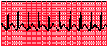 A type of atrial tachycardia as seen on an EKG