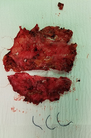 From Dr. Novitsky’s Twitter account: Robotic #meshremoval of intraabdominal mesh makes perfect sense: 3 8mm cuts, control, ability to remove mesh, sutures/tacks