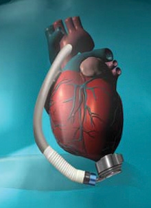 HeartMate III Left Ventricular Assist System