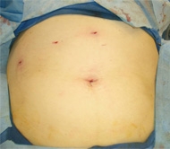 Laparoscopic gallbladder surgery creates small scars.