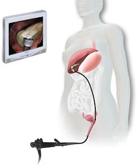 Retro-uterine gall bladder removal
