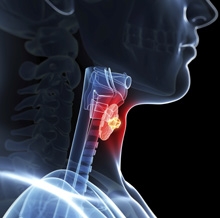 The term thyroid nodule refers to an abnormal growth of thyroid cells that forms a lump within the thyroid gland. Although the vast majority of thyroid nodules are benign (noncancerous), a small proportion of thyroid nodules do contain thyroid cancer.