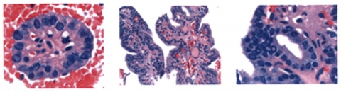 Cytology of papillary thyroid cancer
