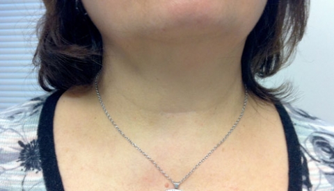 parathyroid thyroid scar swelling