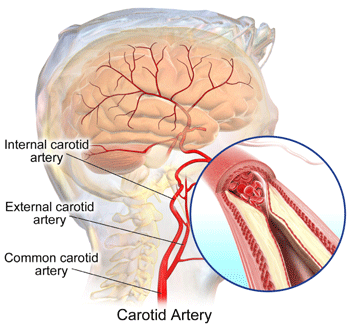Fatty substances and cholesterol can build up in the carotid arteries over time, restricting blood flow to the brain and posing a risk for stroke.