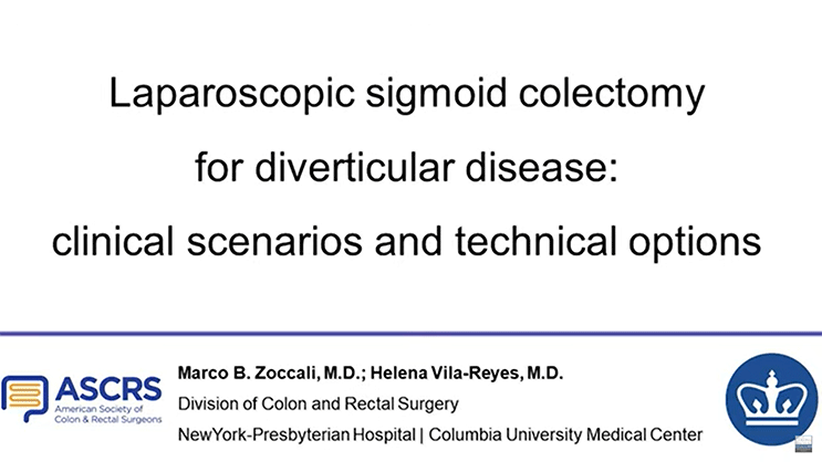 Video Thumbnail: Laparoscopic Sigmoid Colectomy for Diverticular Disease: Clinical Scenarios and Technical Options